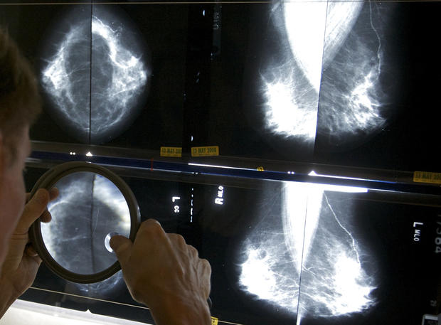 Breast cancer: 6 ways to reduce your risk 