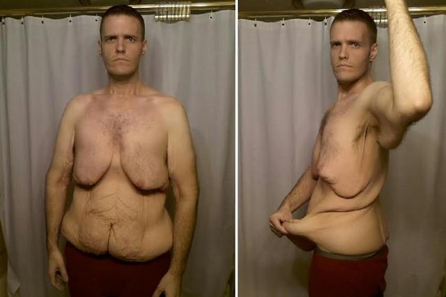 GoFundMe: Canton Man Who Lost 400 Lbs. Needs Surgery To Remove 40
