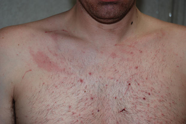 Scratches on Tom Fallis' chest 