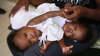 haiti-conjoined-twins.jpg 