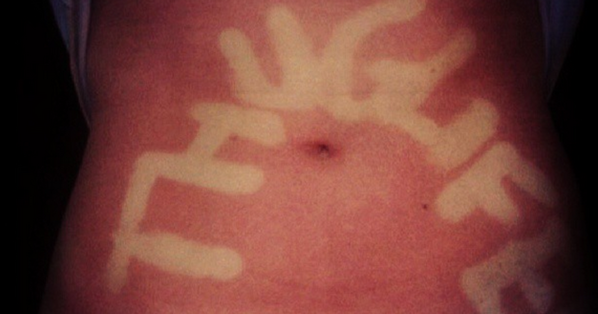 New sunburn tattoo trend isnt so hot according to experts