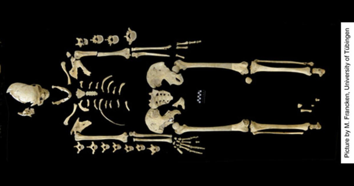 Oldest case of leukemia found in 7,000-year-old skeleton - CBS News