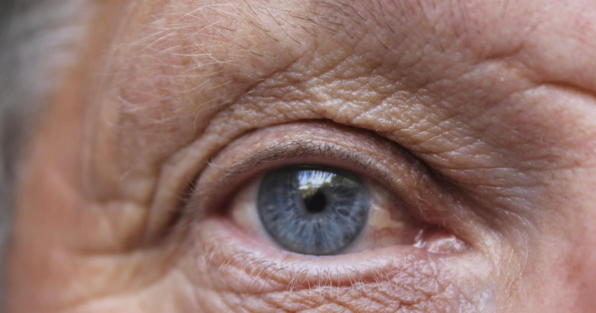 Doctors seek new hope for patients with eye stroke CBS News