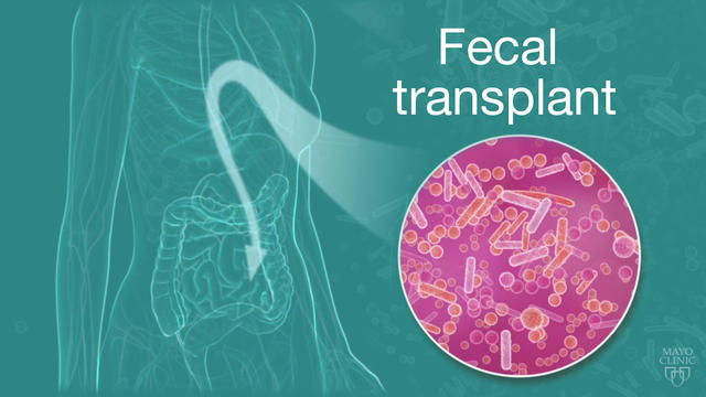 fecal-transplant.jpg 