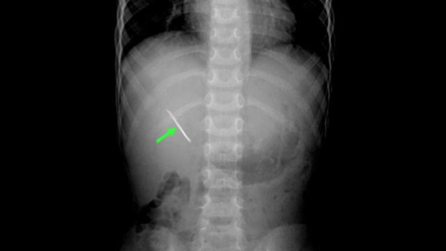 bobby-pin-xray-151105-copy.jpg 