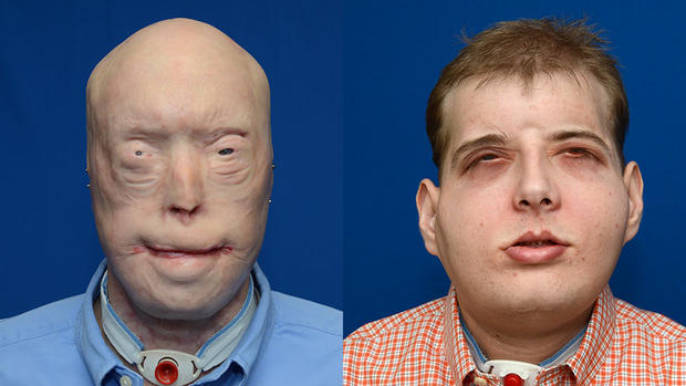 Amazing face transplants (GRAPHIC IMAGES) 