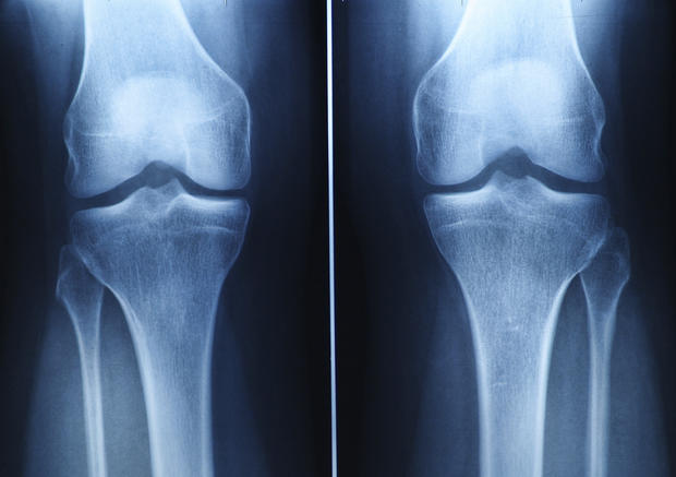 knee-x-ray.jpg 