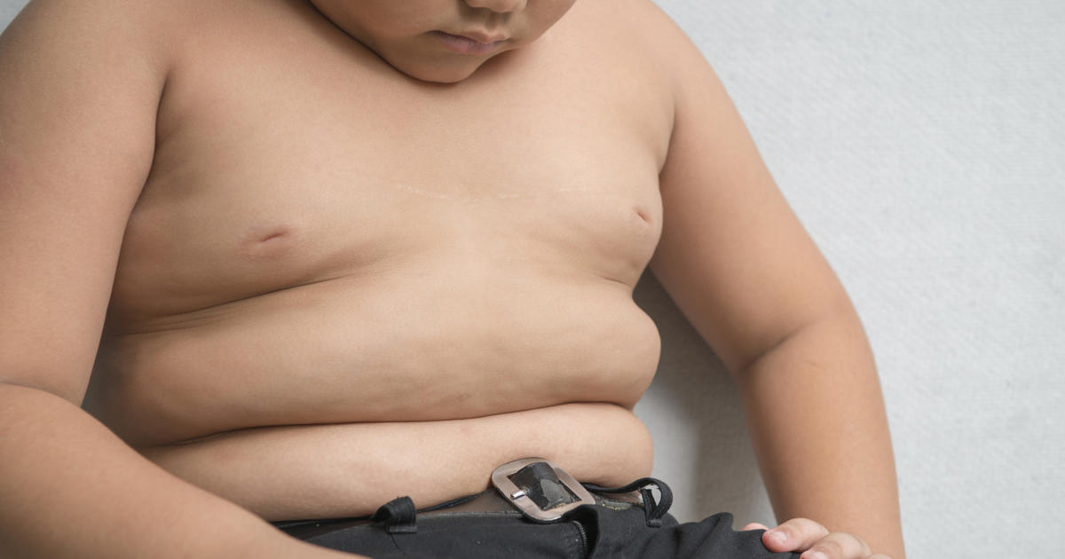 Consider drugs and surgery early for obesity in kids, new guidelines say: 