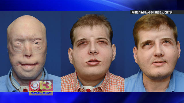 nyu-langone-medical-center-face-transplant.jpg 