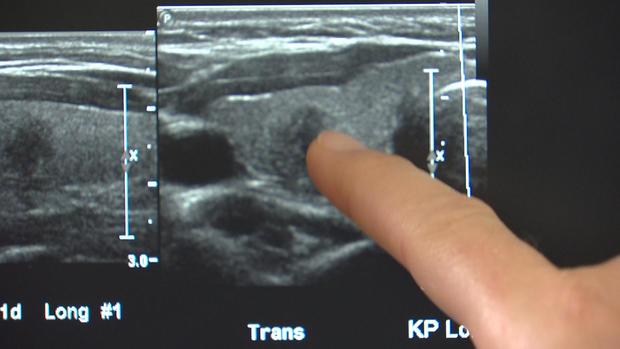 thyroid-surgery-scar-6pkg-transfer 