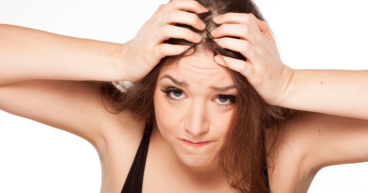 Arthritis drug Xeljanz may help with the hair loss condition alopecia CBS News