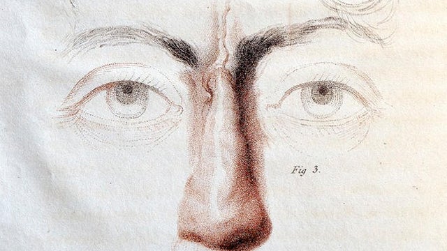 joseph-constantine-carpue-nasal-reconstruction-surgery-promo.jpg 