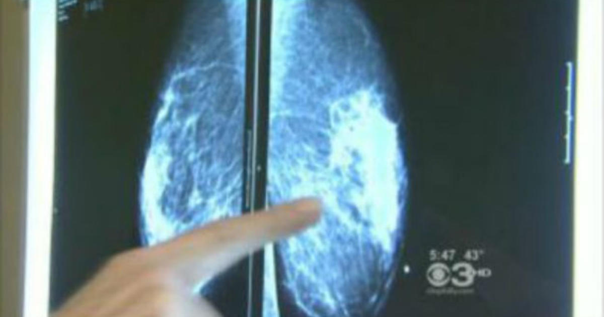 morning-people-may-have-lower-risk-of-breast-cancer-study-finds-cbs-philadelphia