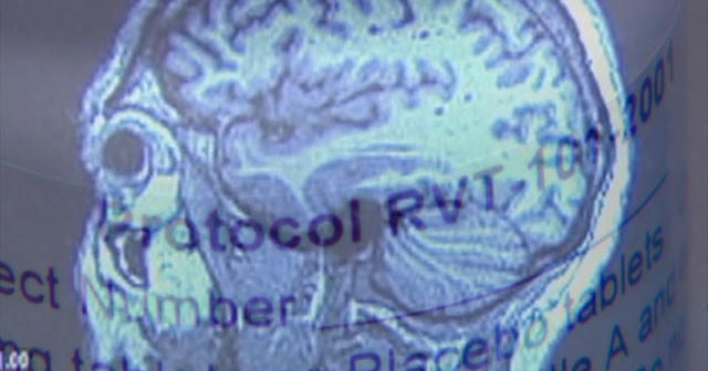 Experimental drug being tested for Lewy body dementia CBS News