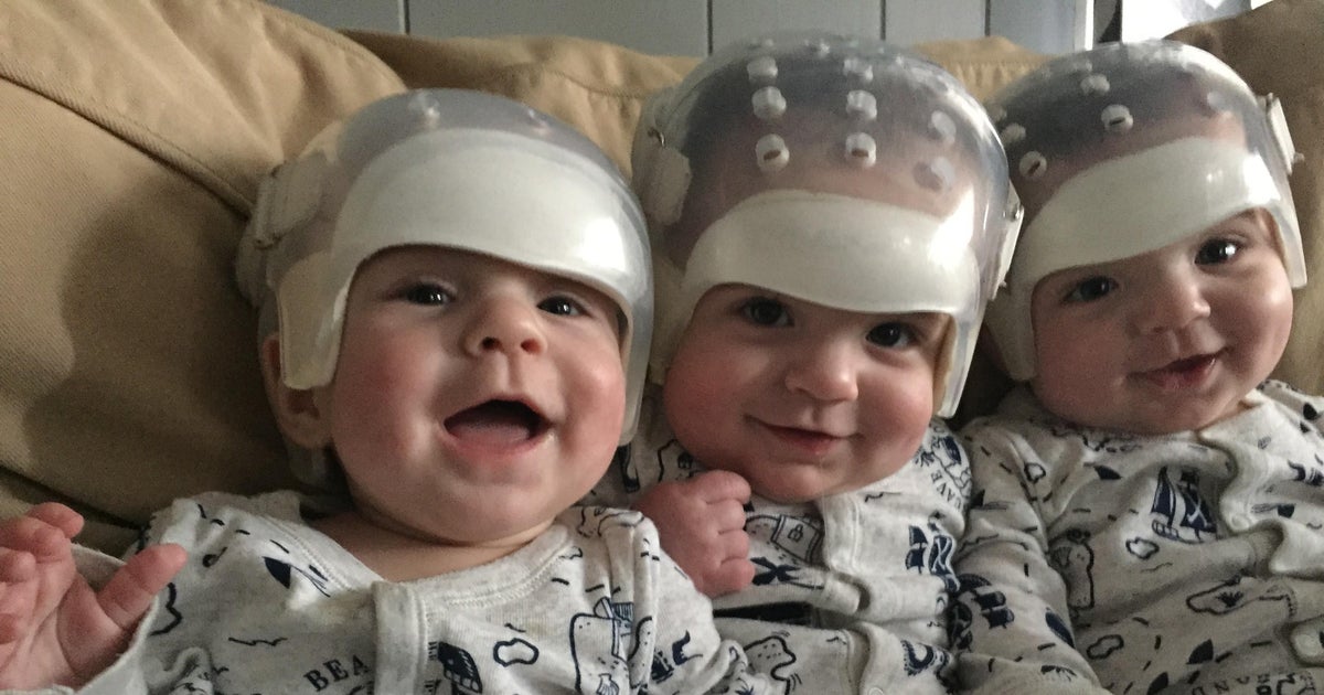 Doctors repair skulls of triplets born with rare condition CBS News