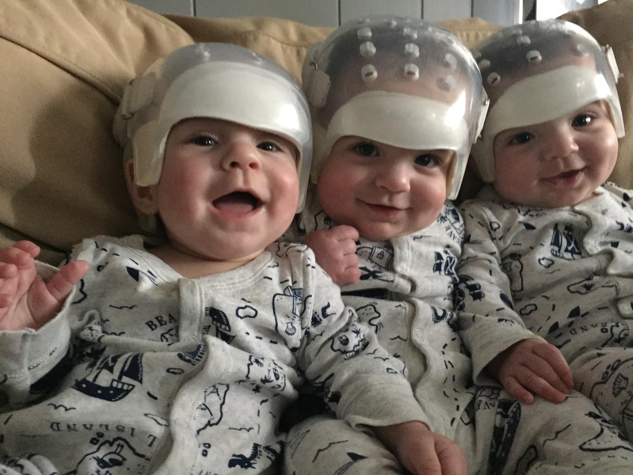 Doctors repair skulls of triplets born with rare condition - CBS News