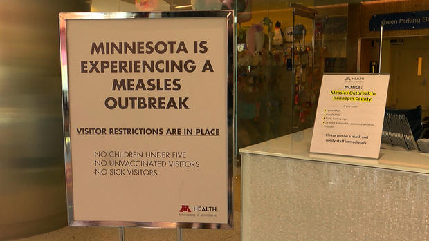 Measles Outbreak Sign 