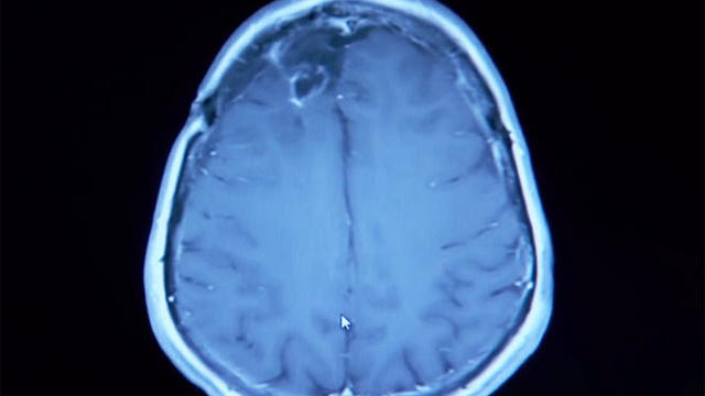 brain-cancer-duke-university-clinical-trial-promo.jpg 