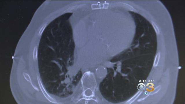 lung-cancer-scan-screening.jpg 