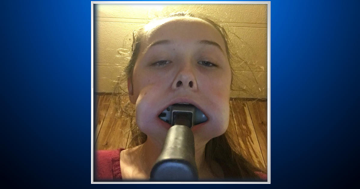Teen Girl Gets Hammer Stuck In Mouth On A Dare Cbs Colorado 
