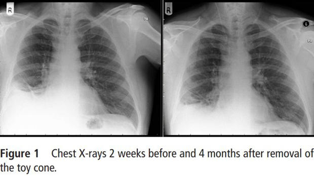 X-ray 