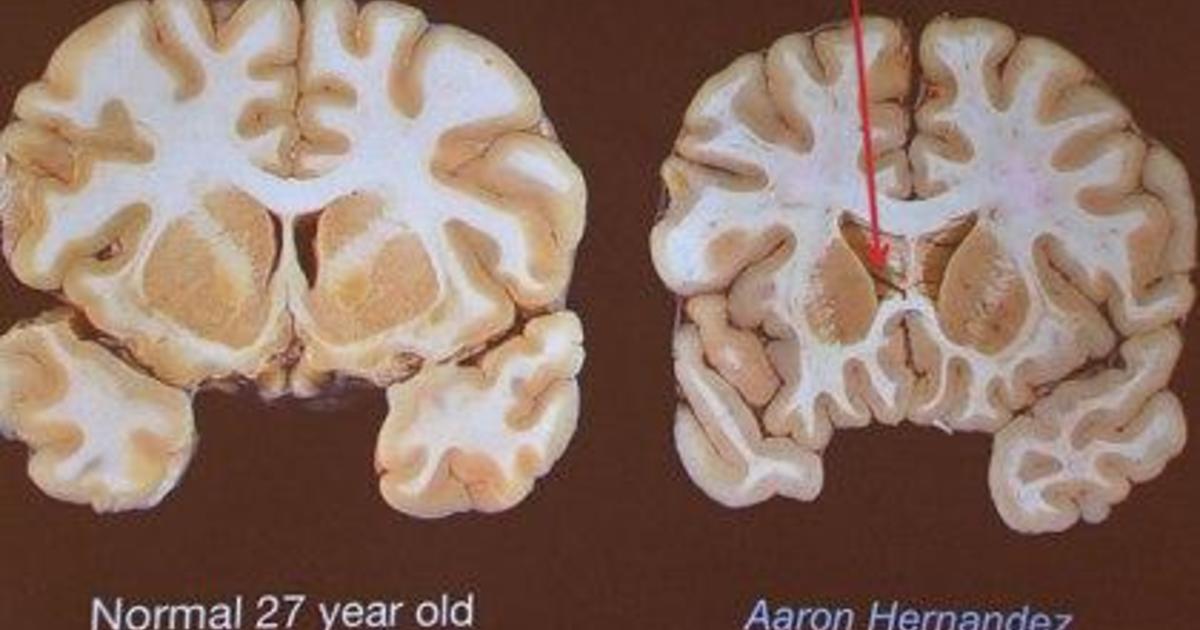 Aaron Hernandez lawyer: Brain showed 'severe' case of CTE