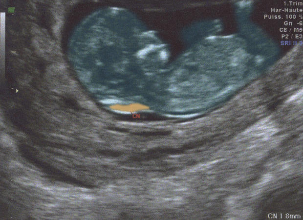 Fetus Ultrasound Scan 