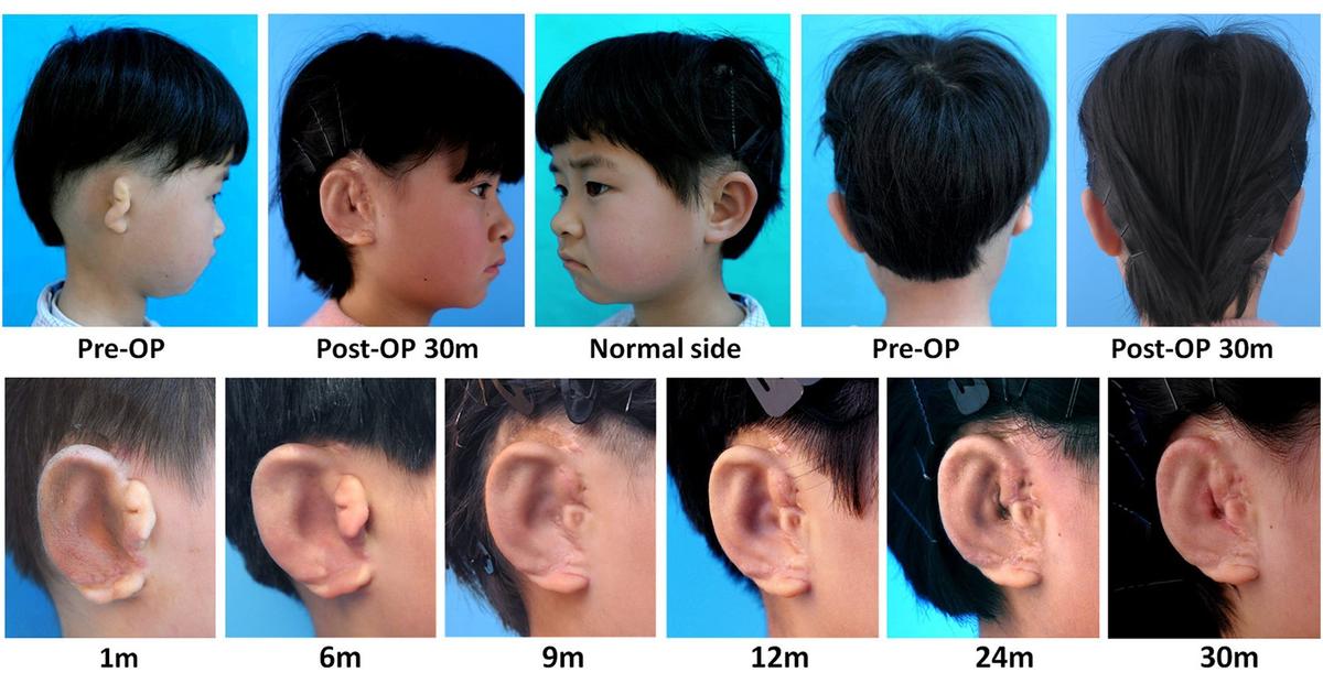 Children's hospital creates custom glasses system for child with ear  deformity - ABC News