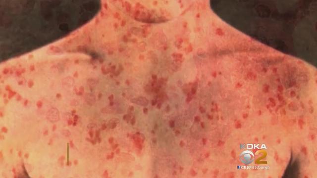 measles2.jpg 