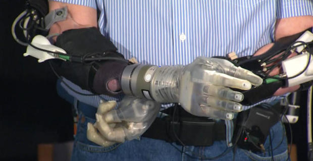 manchester NH bionic arm 