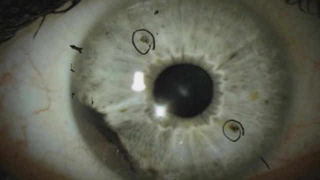 0430-ctm-eyecancercases-werner-1558175-640x360.jpg 