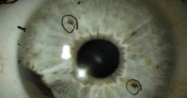 CBS News report on rare eye cancer gets widespread response CBS News