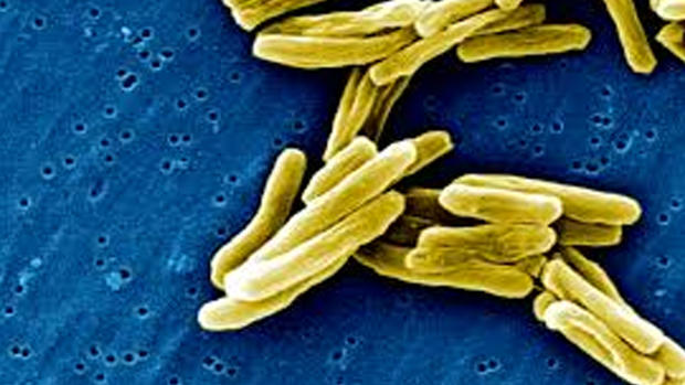 Tuberculosis Pennsylvania department of health 