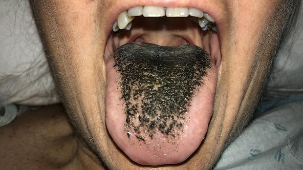 Black Hairy Tongue 