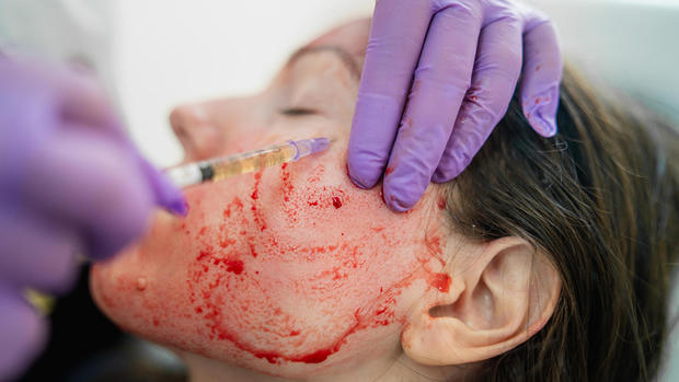 'Vampire facial' may have exposed spa clients to HIV 