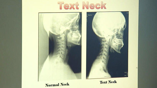 text neck 