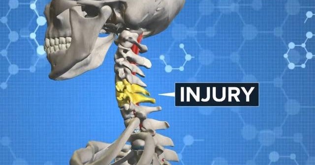 New technology helps paralyzed people walk again CBS News