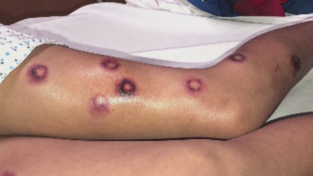 14-Year-Old Recovers From Paintball Attack 