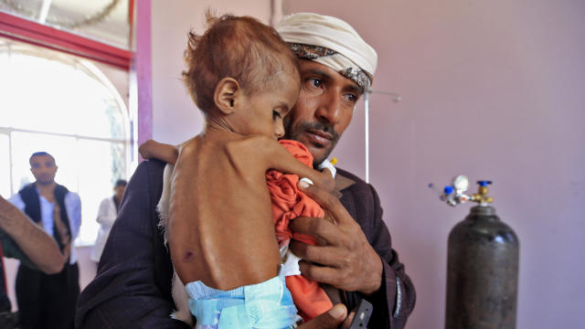 YEMEN-CONFLICT-MALNUTRITION 