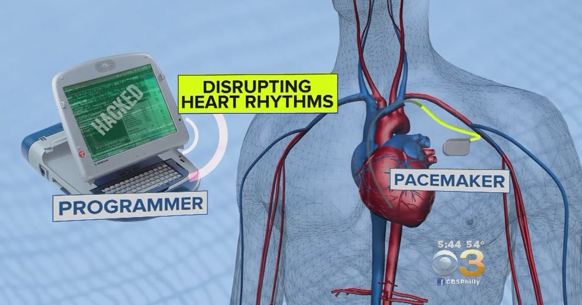 Pacemakers, Implanted Medical Devices Could Be Hacked To Hurt Or Kill