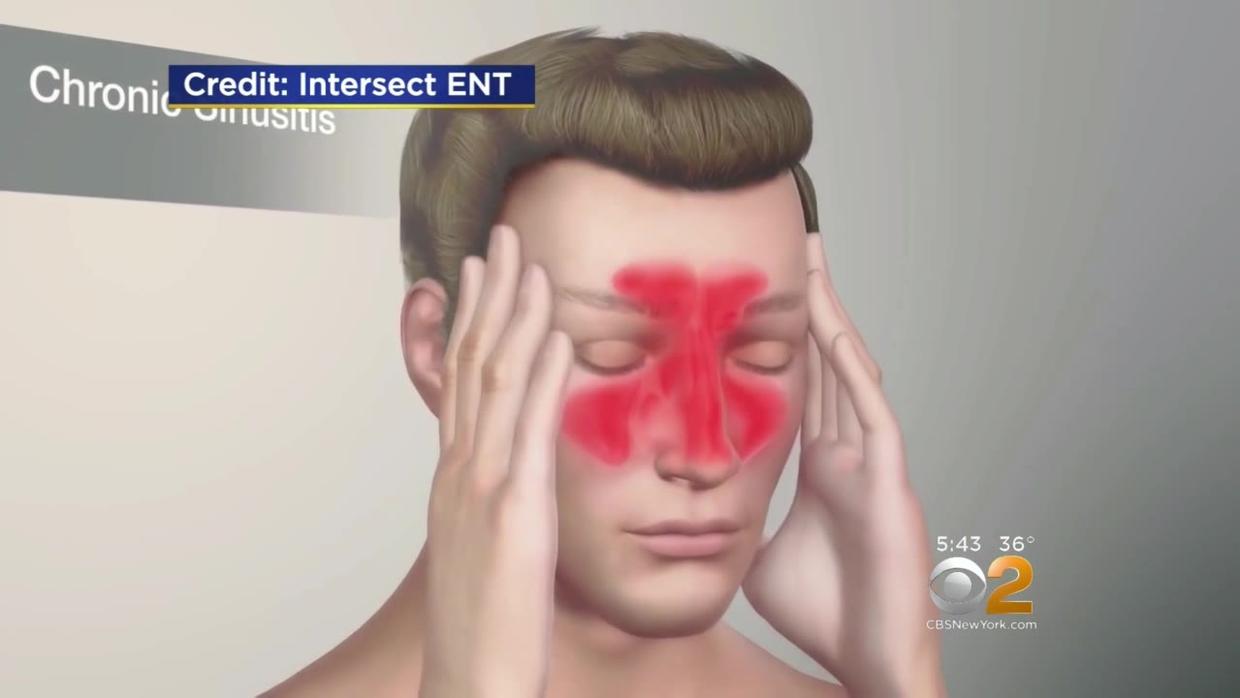 Healthwatch Combating Chronic Sinusitis Cbs New York