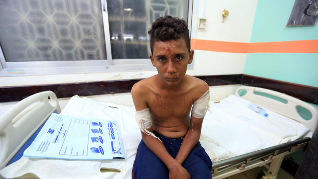 Malnourished Ghazi Ahmad, 10, lies on a bed at a hospital in Taiz, Yemen, Oct. 30, 2018. 