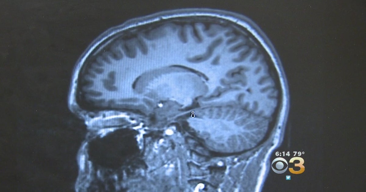 Woman Dies From BrainEating Amoeba After Improperly Using Neti Pot