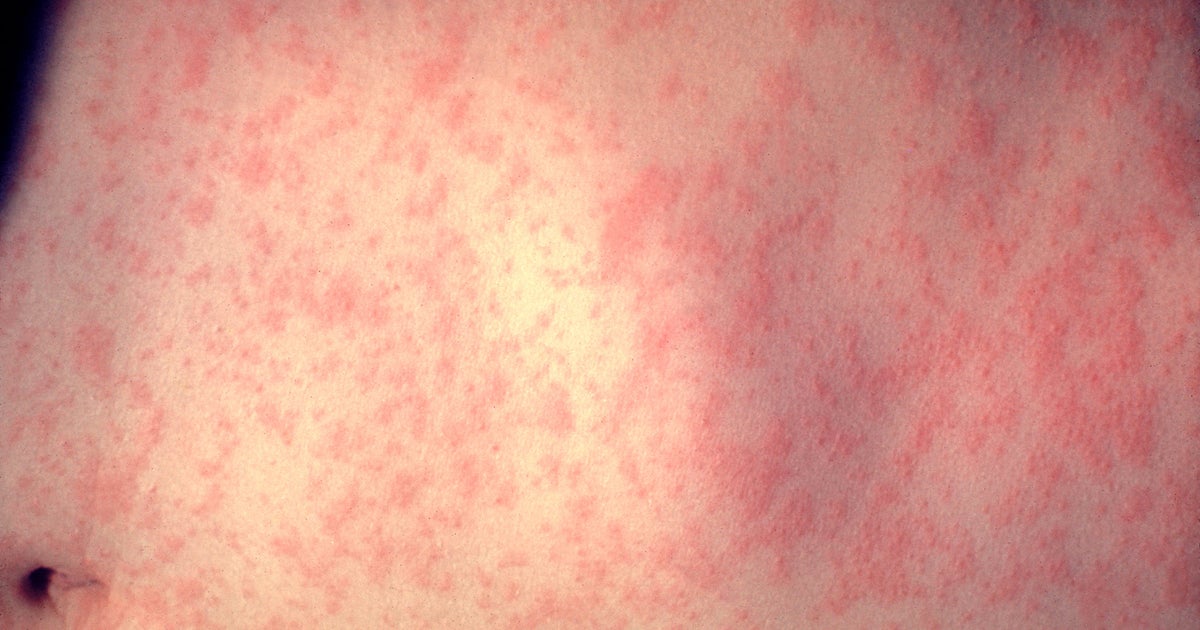 Traveler with measles was at Newark Airport while infectious, health officials say