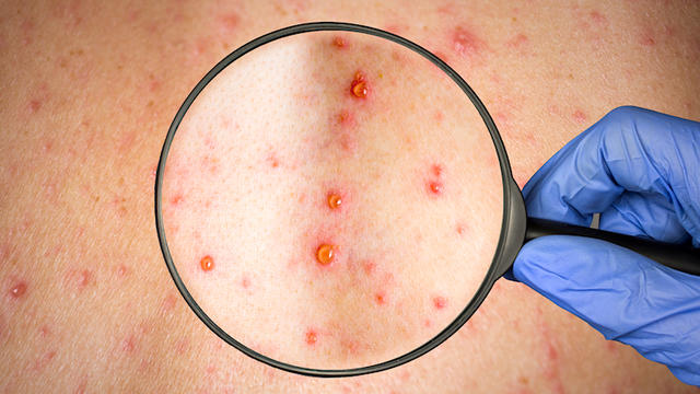 measles-1046256020.jpg 