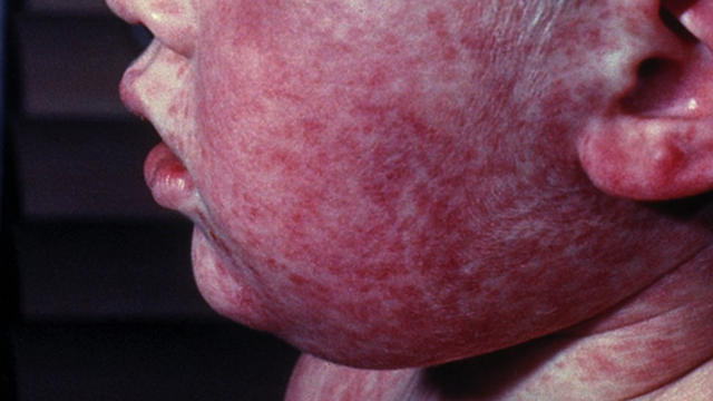 measles-2.jpg 