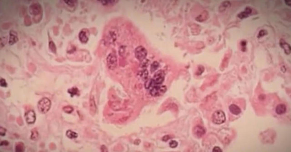U.S. measles cases reach record levels CBS News