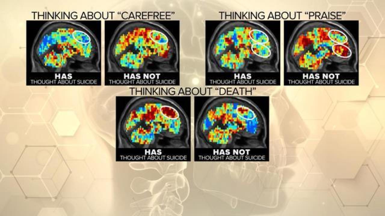 Can fMRI brain scans spot suicidal thoughts? - CBS News