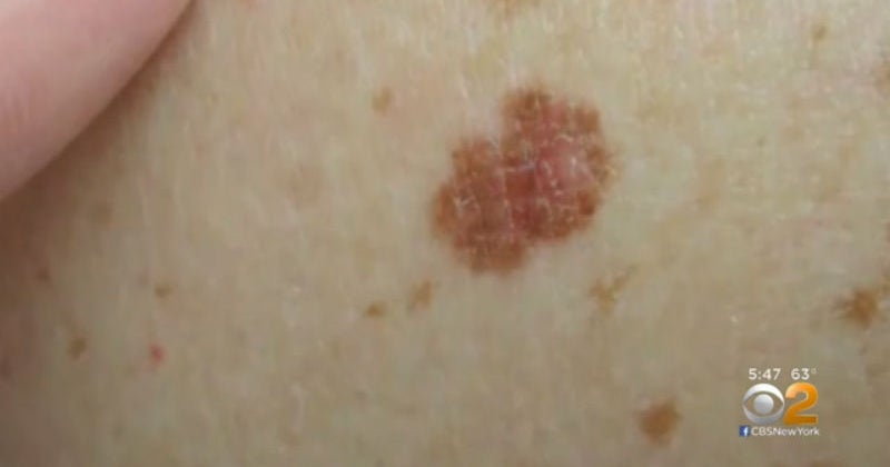 "Melanoma Monday" emphasizes importance of regular cancer screening