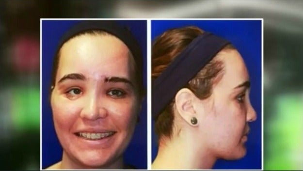 Facial reconstruction 